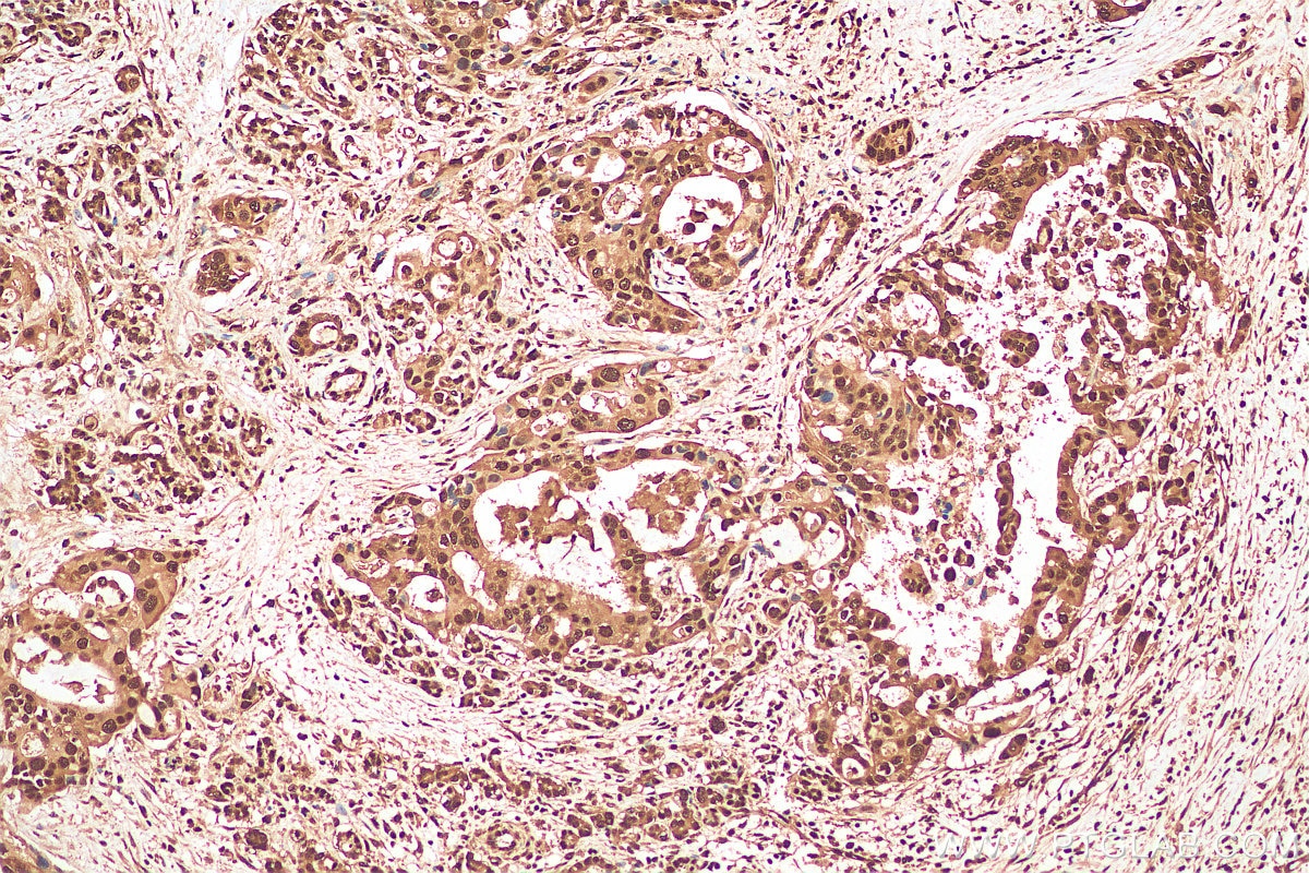 Immunohistochemistry (IHC) staining of human pancreas cancer tissue using ubiquitin Polyclonal antibody (10201-2-AP)