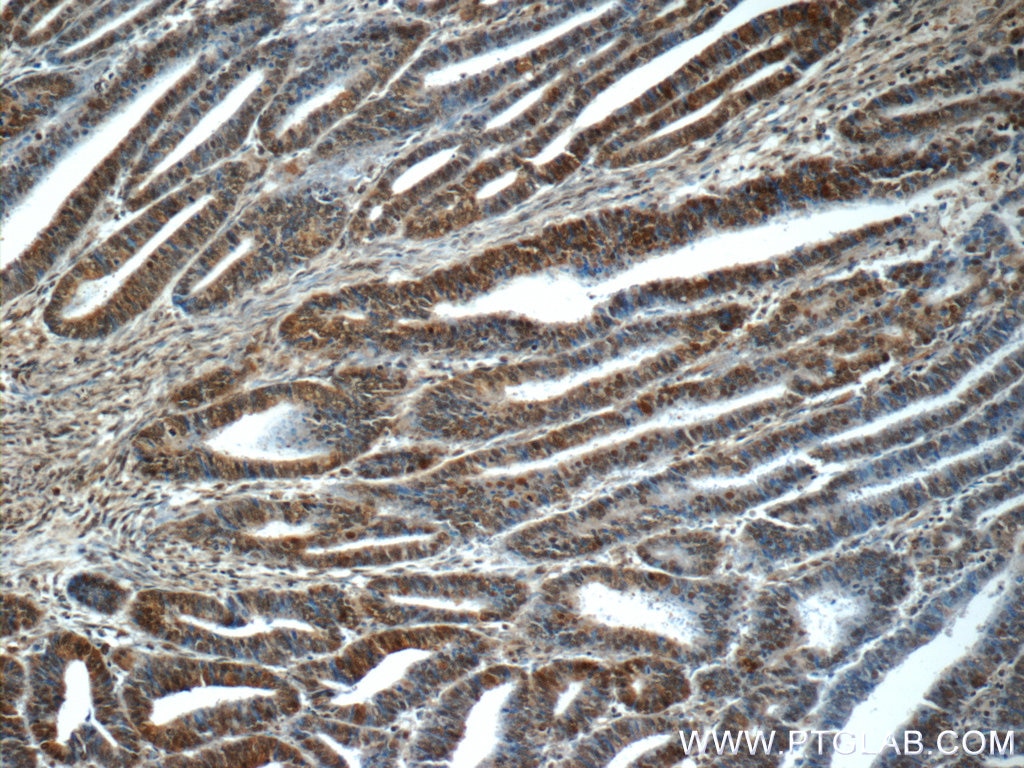 Immunohistochemistry (IHC) staining of human endometrial cancer tissue using RPS27A Polyclonal antibody (14946-1-AP)