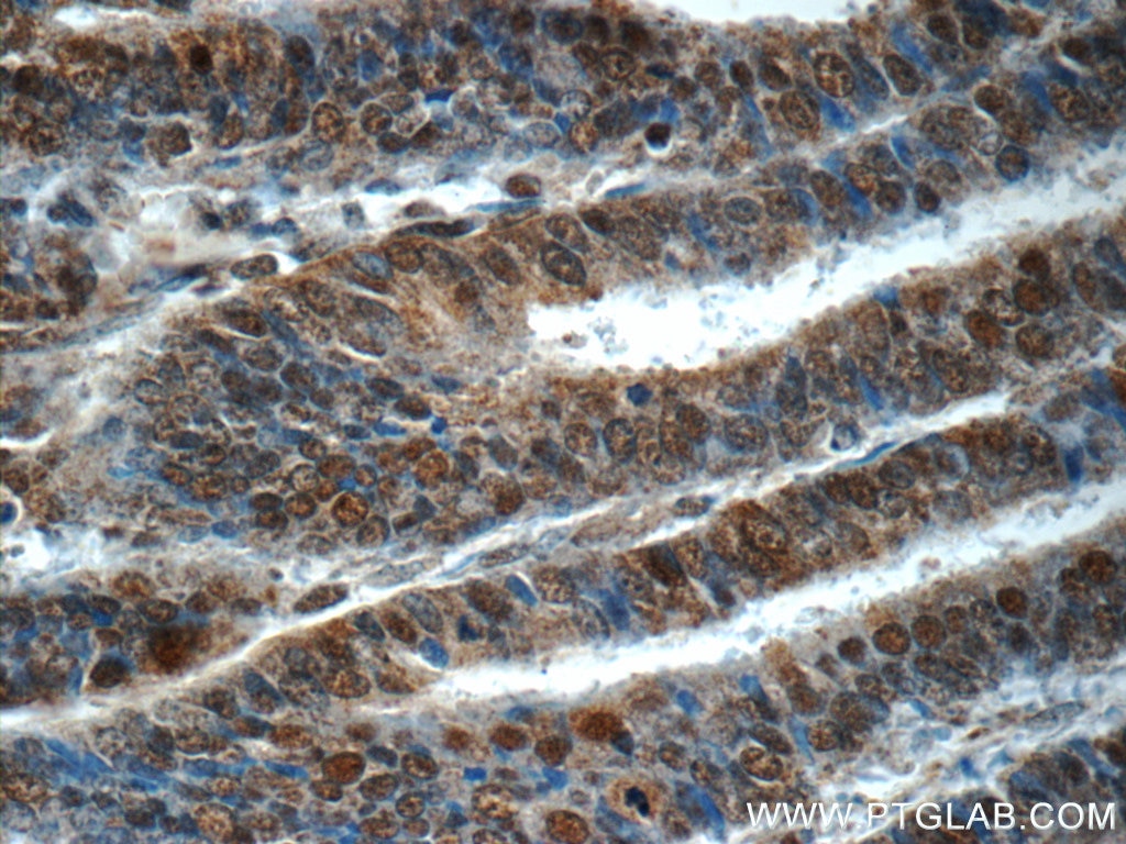 Immunohistochemistry (IHC) staining of human endometrial cancer tissue using RPS27A Polyclonal antibody (14946-1-AP)