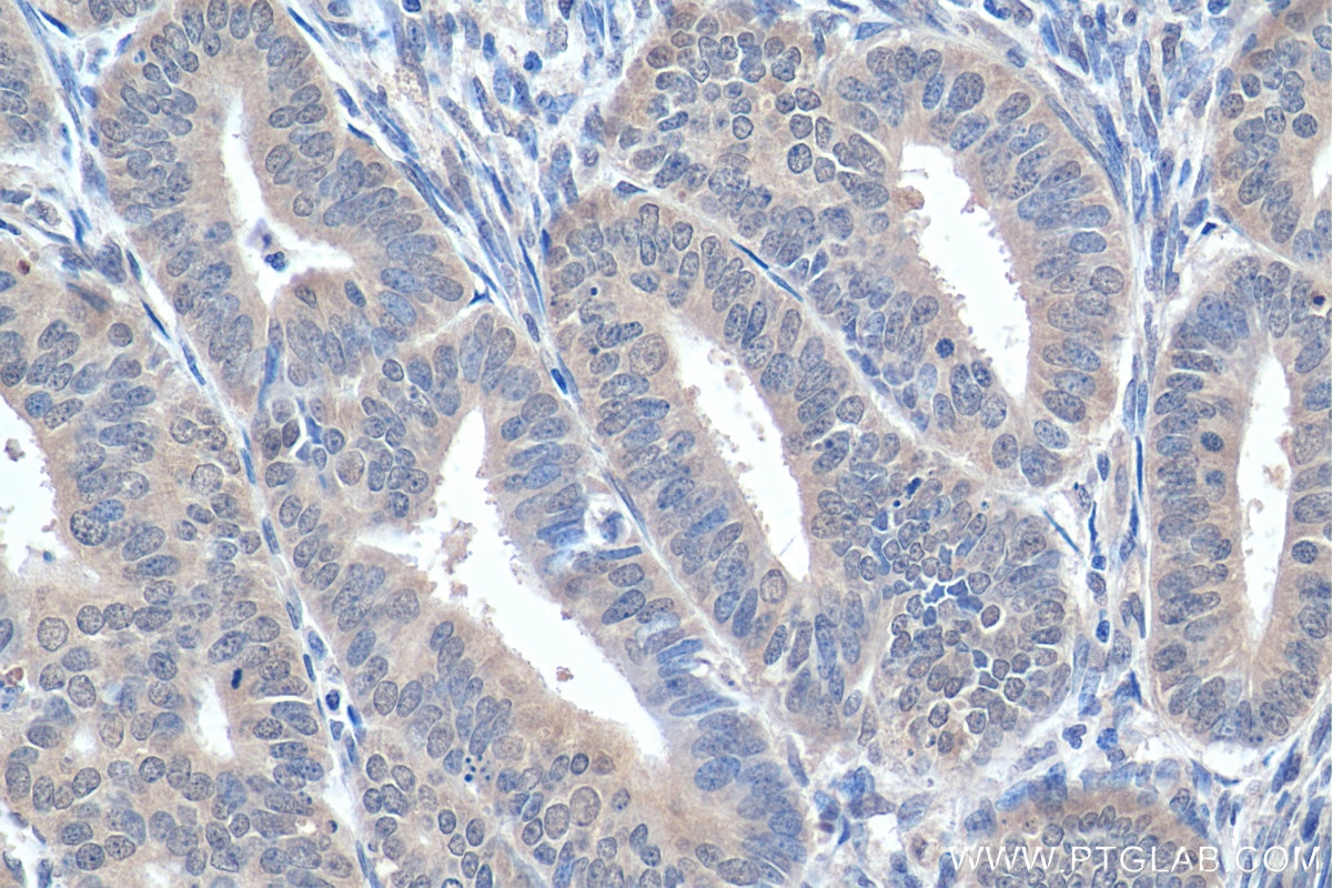 IHC staining of human endometrial cancer using 14946-1-AP