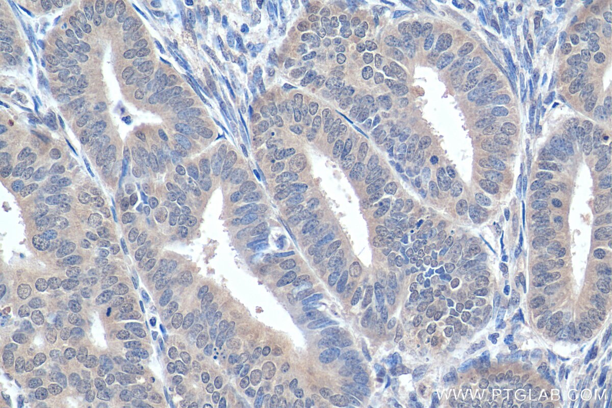 Immunohistochemistry (IHC) staining of human endometrial cancer tissue using RPS27A Polyclonal antibody (14946-1-AP)