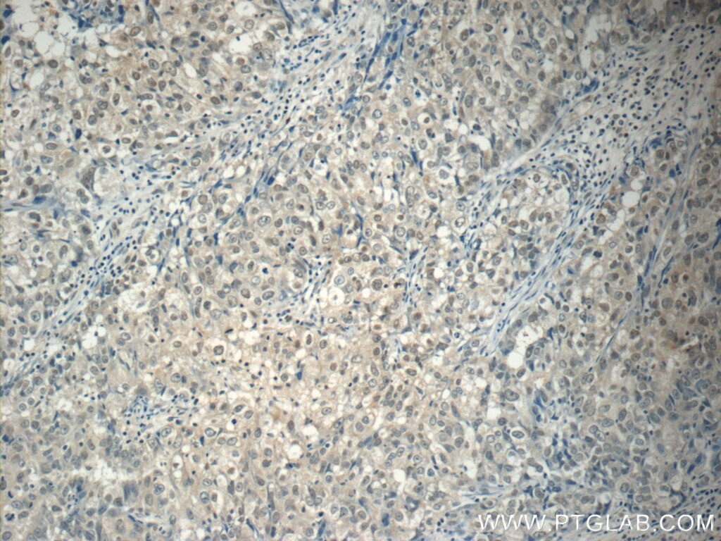 IHC staining of human breast cancer using 60310-1-Ig