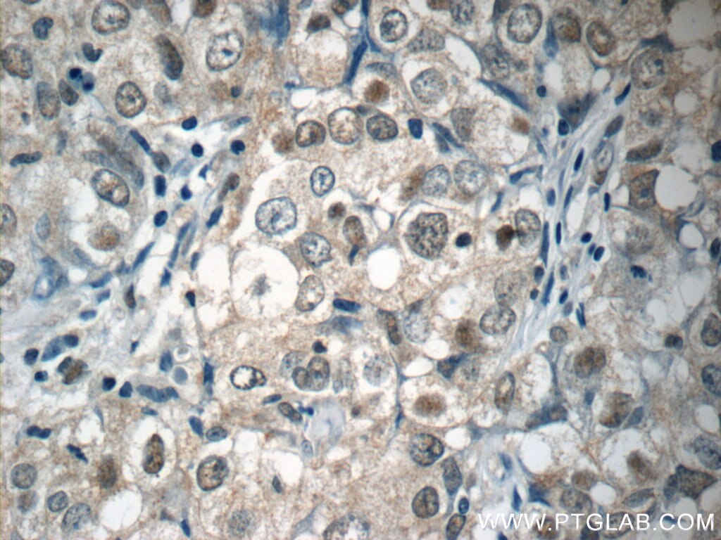 Immunohistochemistry (IHC) staining of human breast cancer tissue using ubiquitin Monoclonal antibody (60310-1-Ig)