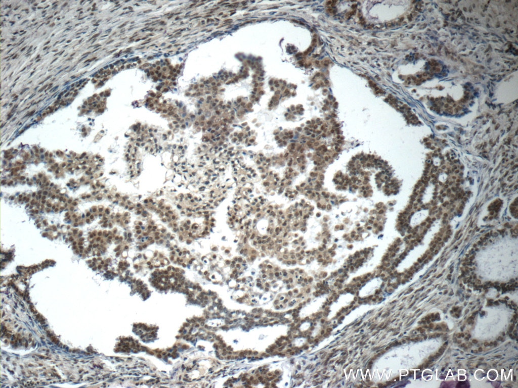 Immunohistochemistry (IHC) staining of human ovary tumor tissue using ubiquitin Monoclonal antibody (60310-1-Ig)
