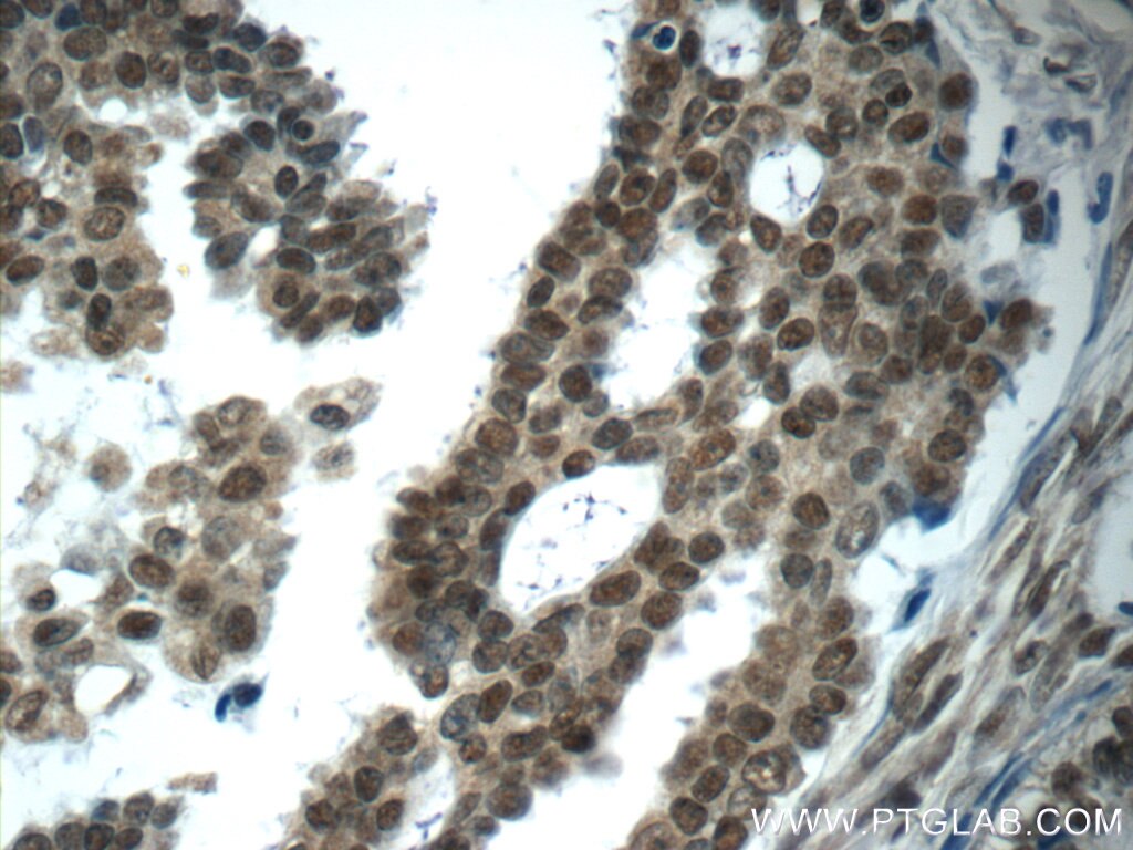 Immunohistochemistry (IHC) staining of human ovary tumor tissue using ubiquitin Monoclonal antibody (60310-1-Ig)