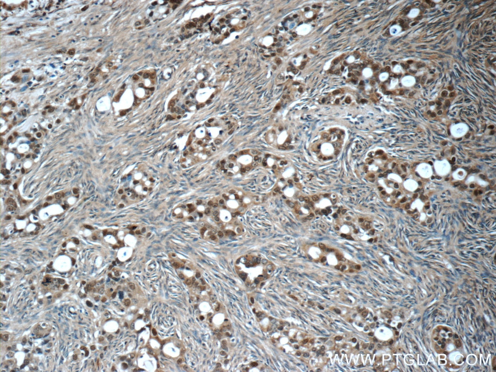 Immunohistochemistry (IHC) staining of human ovary tumor tissue using ubiquitin Monoclonal antibody (60310-1-Ig)