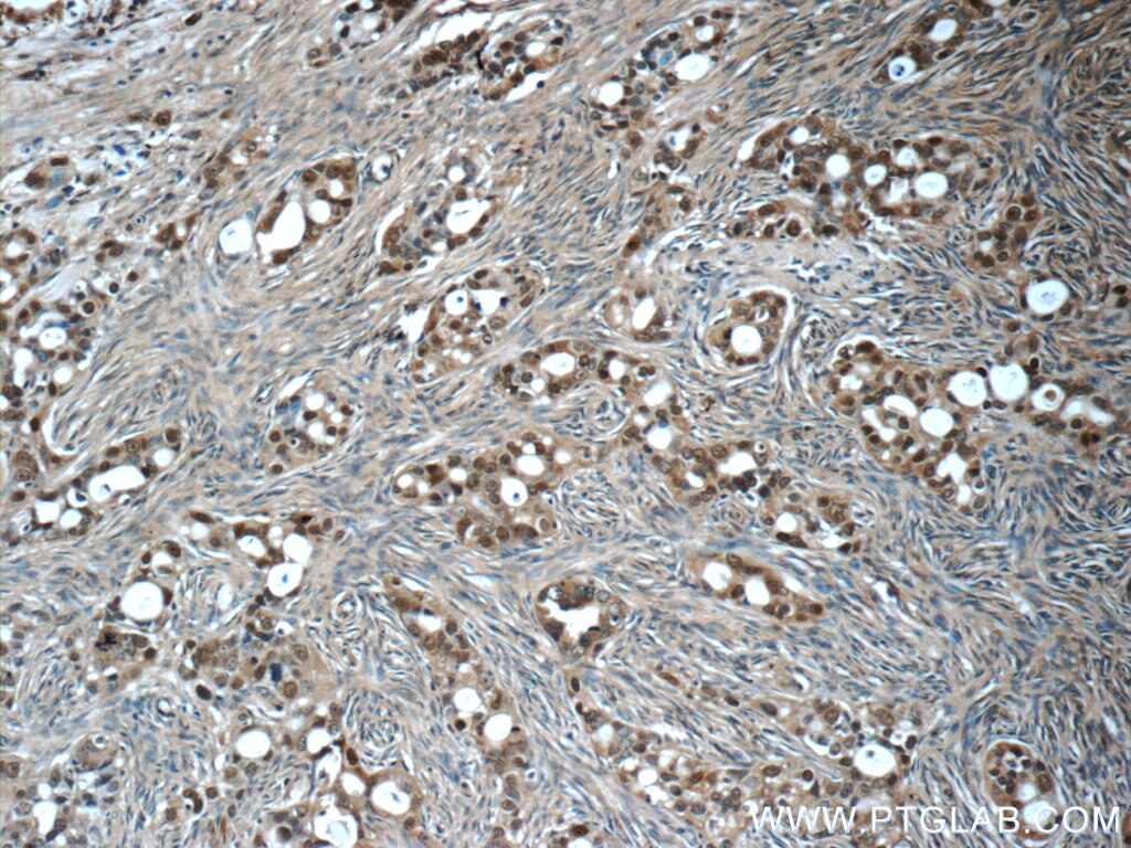 Immunohistochemistry (IHC) staining of human ovary tumor tissue using ubiquitin Monoclonal antibody (60310-1-Ig)