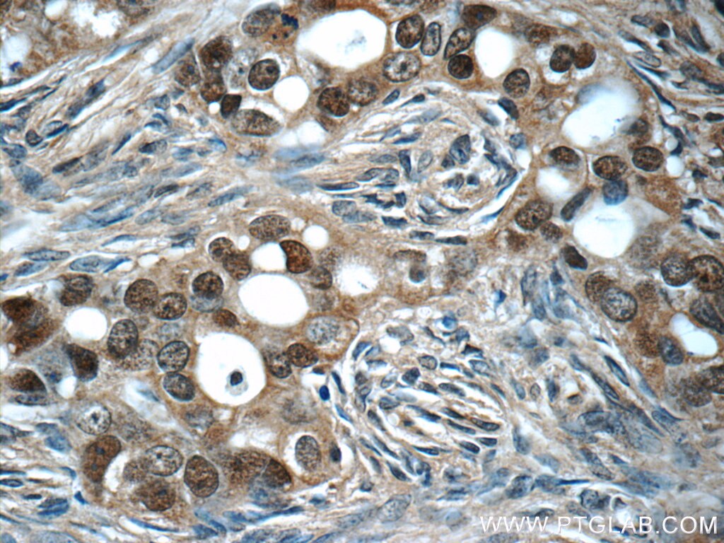 Immunohistochemistry (IHC) staining of human ovary tumor tissue using ubiquitin Monoclonal antibody (60310-1-Ig)