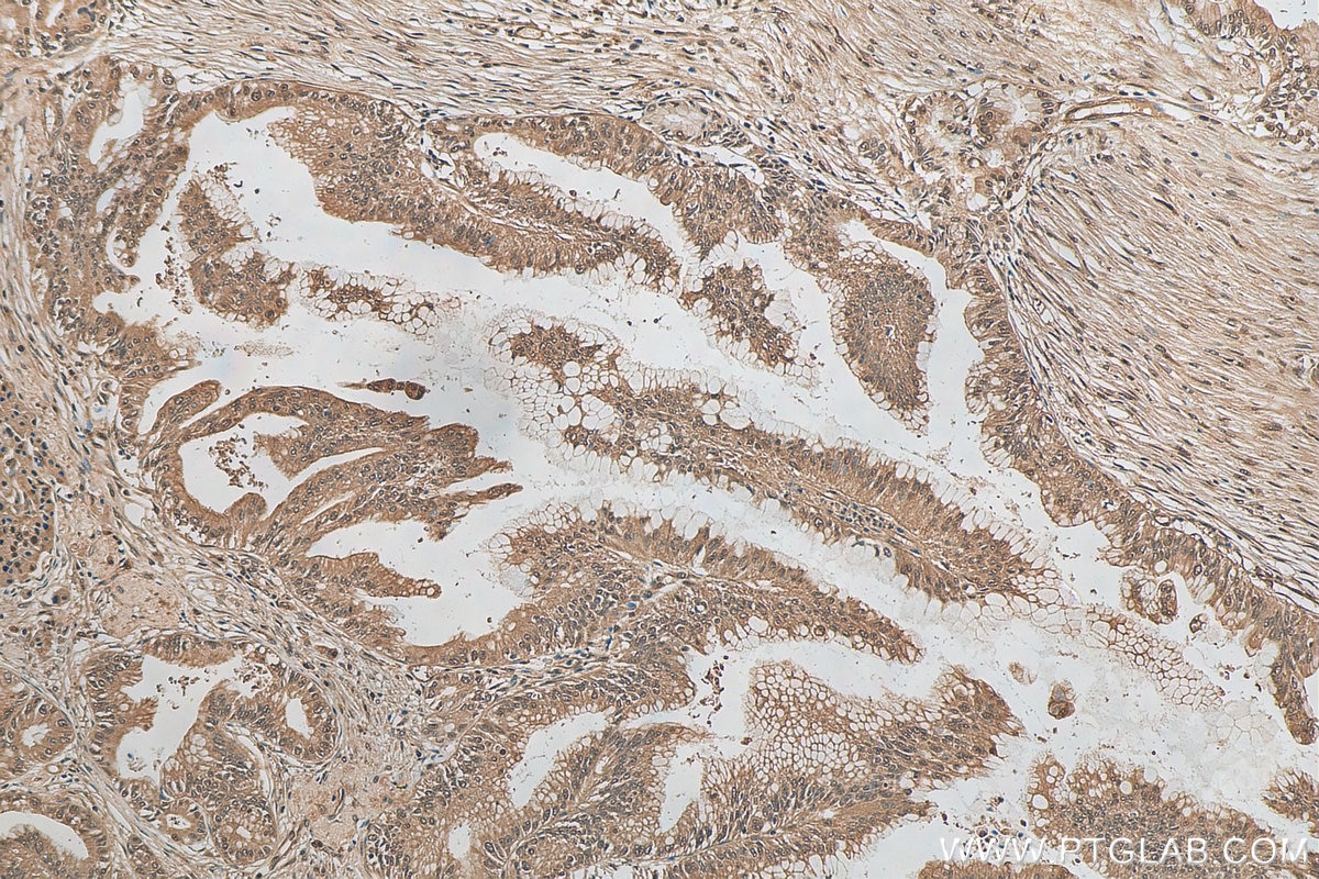 Immunohistochemistry (IHC) staining of human pancreas cancer tissue using ubiquitin Recombinant antibody (80992-1-RR)