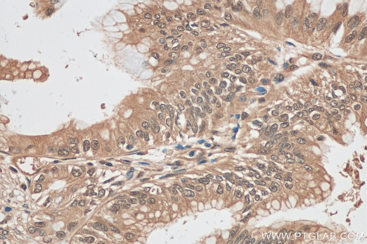 Immunohistochemistry (IHC) staining of human pancreas cancer tissue using ubiquitin Recombinant antibody (80992-1-RR)