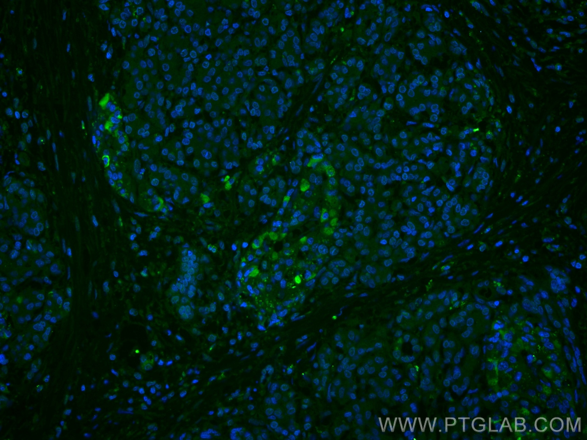 Immunofluorescence (IF) / fluorescent staining of human pancreas cancer tissue using CoraLite® Plus 488-conjugated ubiquitin Polyclonal (CL488-10201)