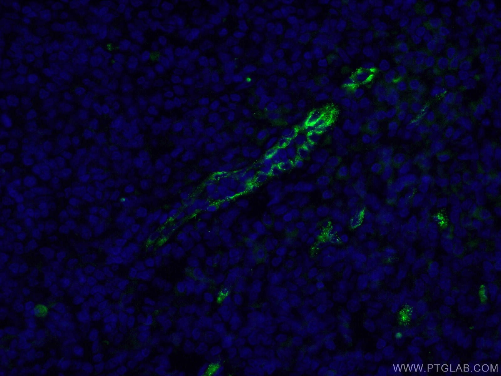 IF Staining of human tonsillitis using 27186-1-AP