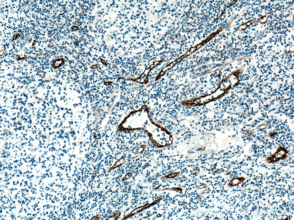 Immunohistochemistry (IHC) staining of human tonsillitis tissue using VWF Polyclonal antibody (27186-1-AP)