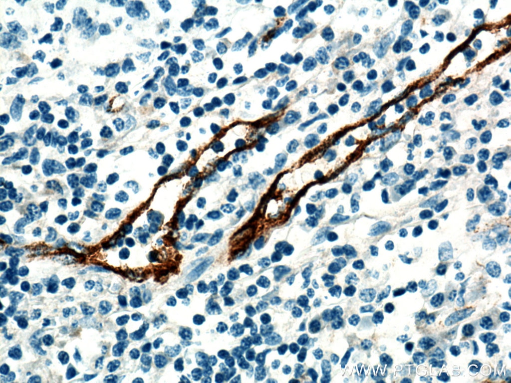 IHC staining of human tonsillitis using 27186-1-AP