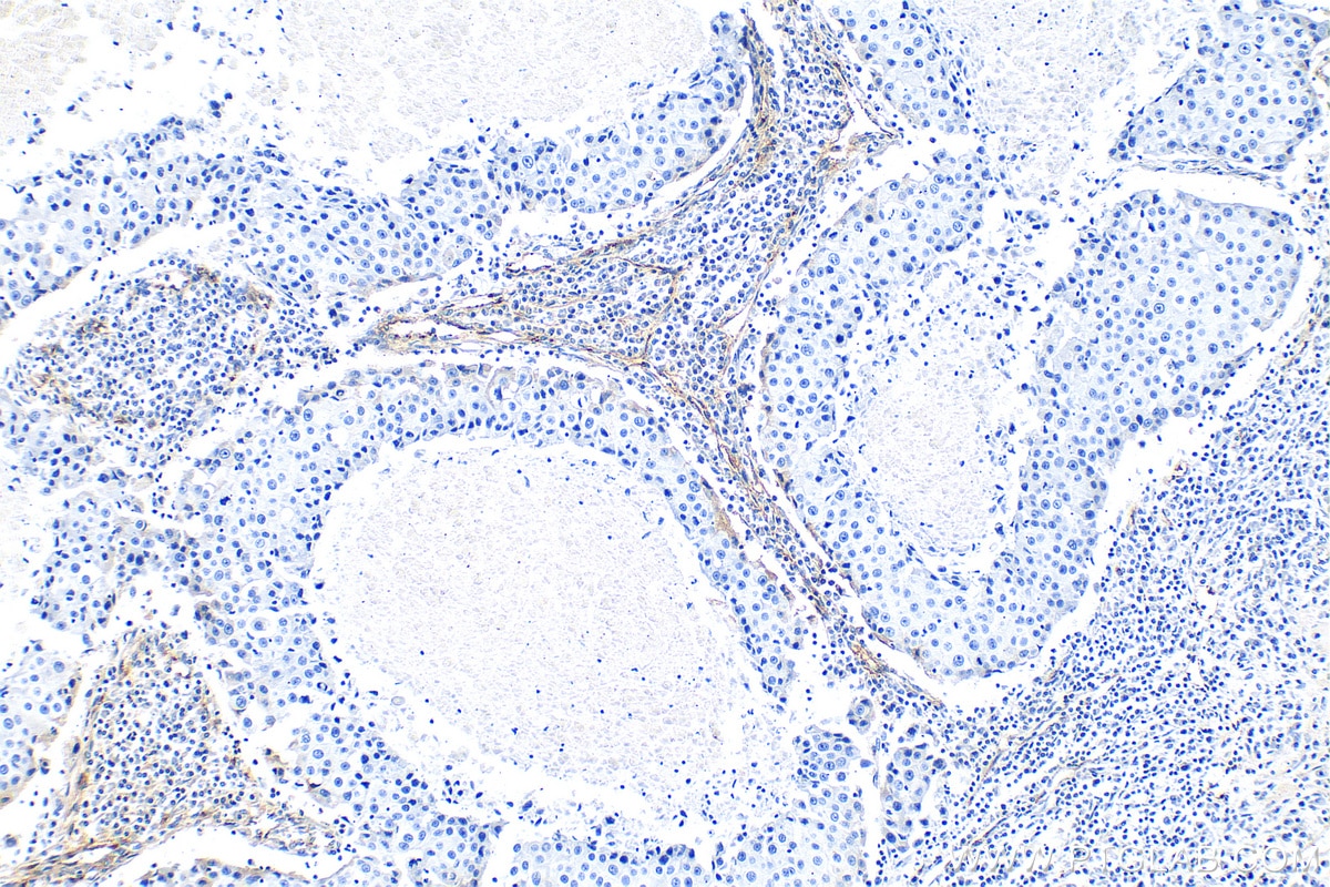 Immunohistochemistry (IHC) staining of human breast cancer tissue using VWF Polyclonal antibody (27186-1-AP)