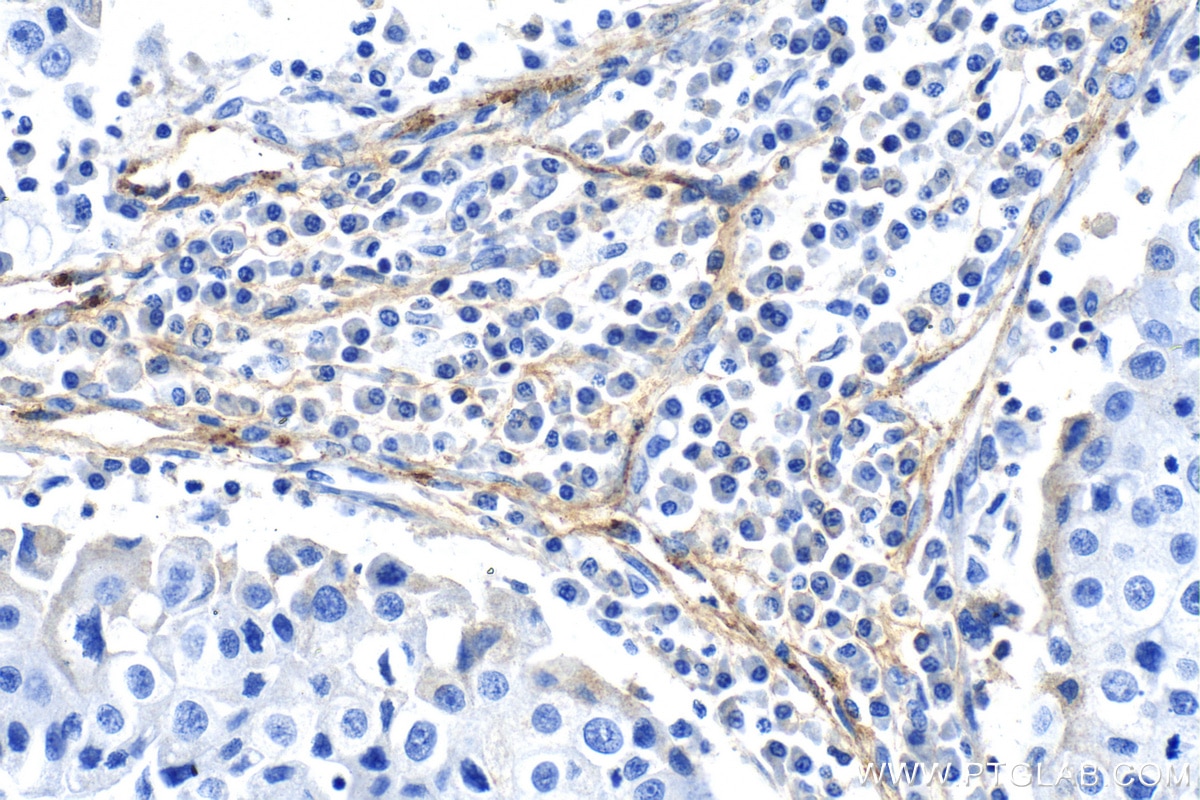 Immunohistochemistry (IHC) staining of human breast cancer tissue using VWF Polyclonal antibody (27186-1-AP)