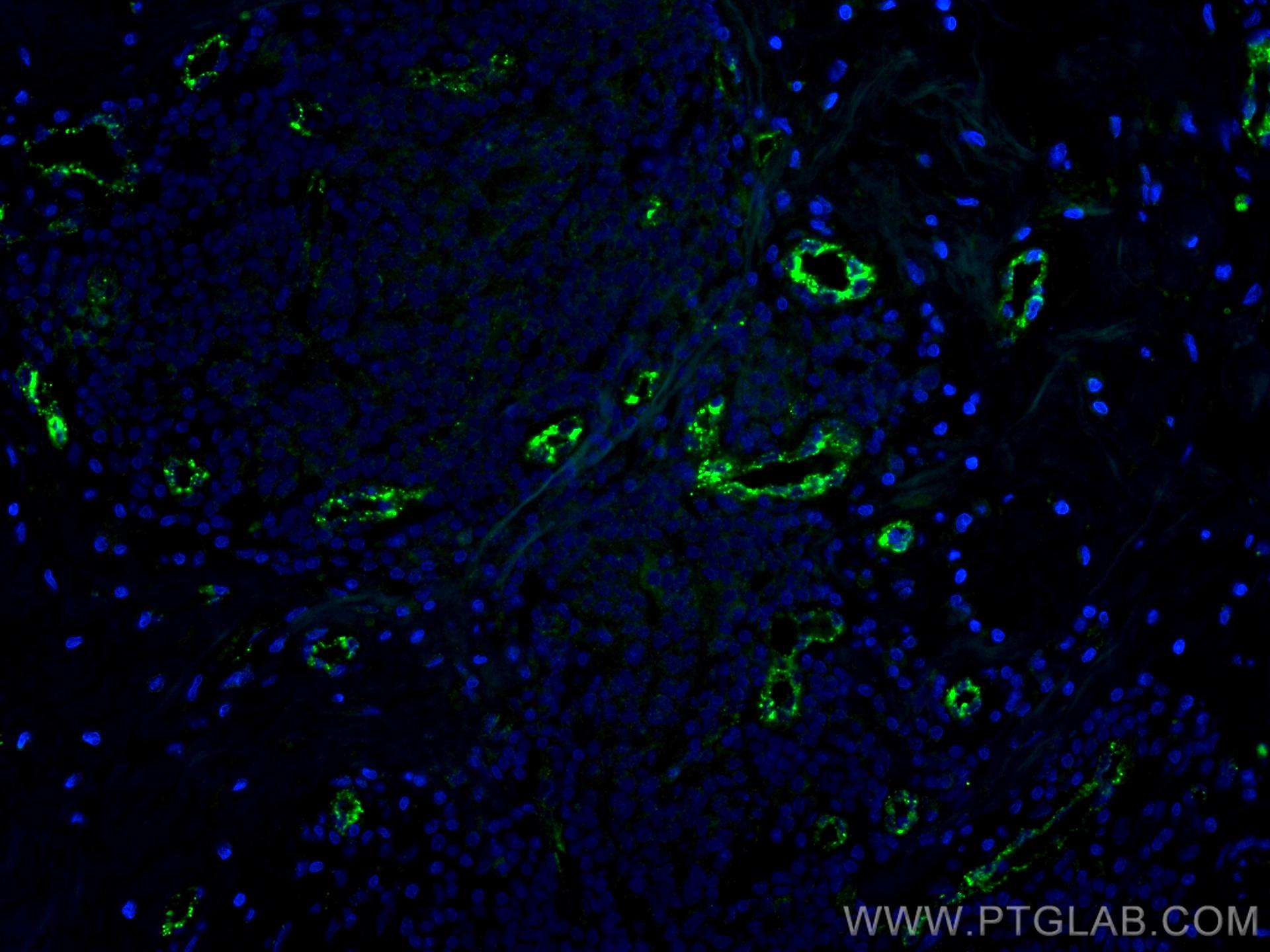Immunofluorescence (IF) / fluorescent staining of human breast cancer tissue using VWF Monoclonal antibody (66682-1-Ig)