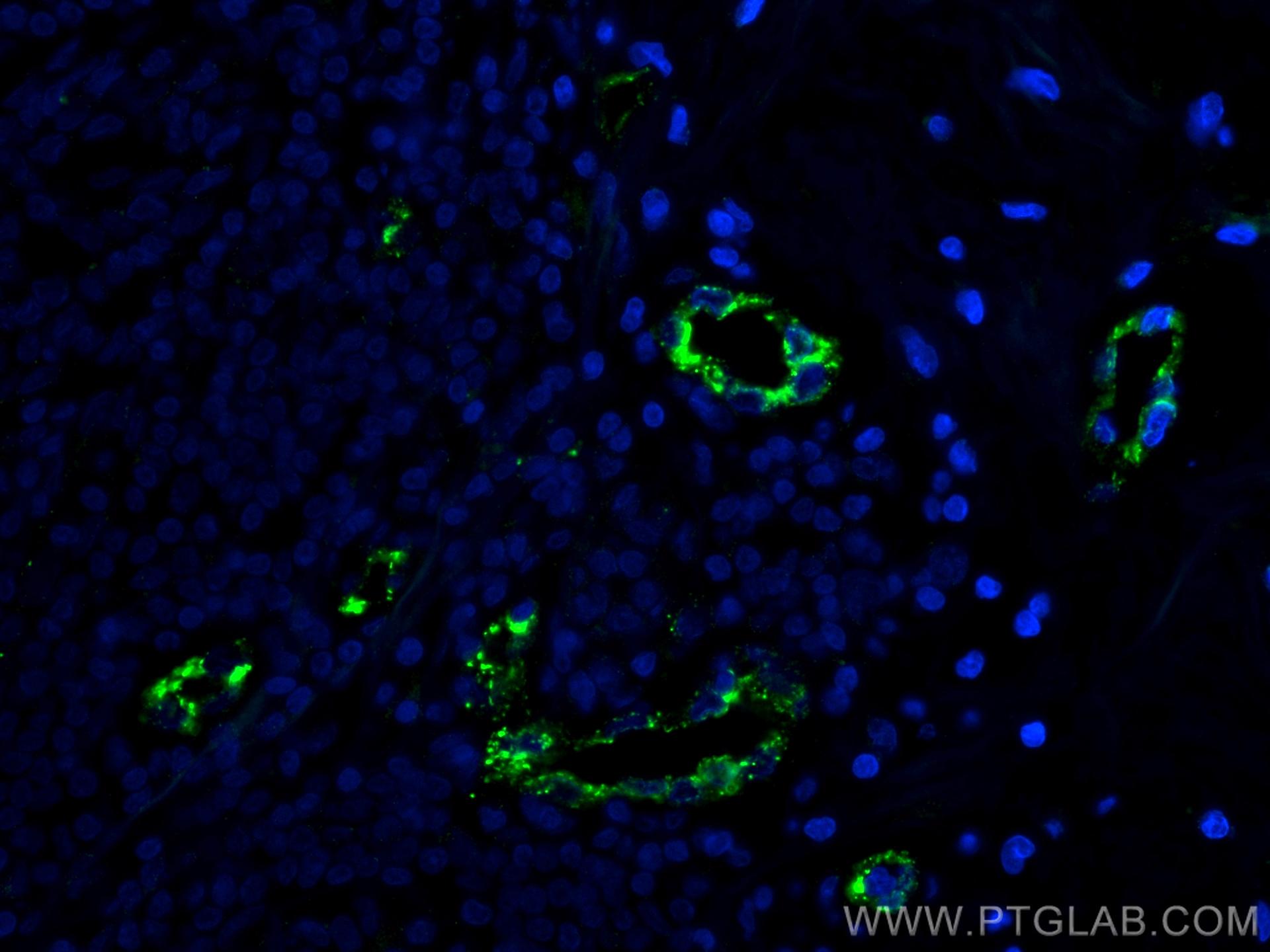 Immunofluorescence (IF) / fluorescent staining of human breast cancer tissue using VWF Monoclonal antibody (66682-1-Ig)