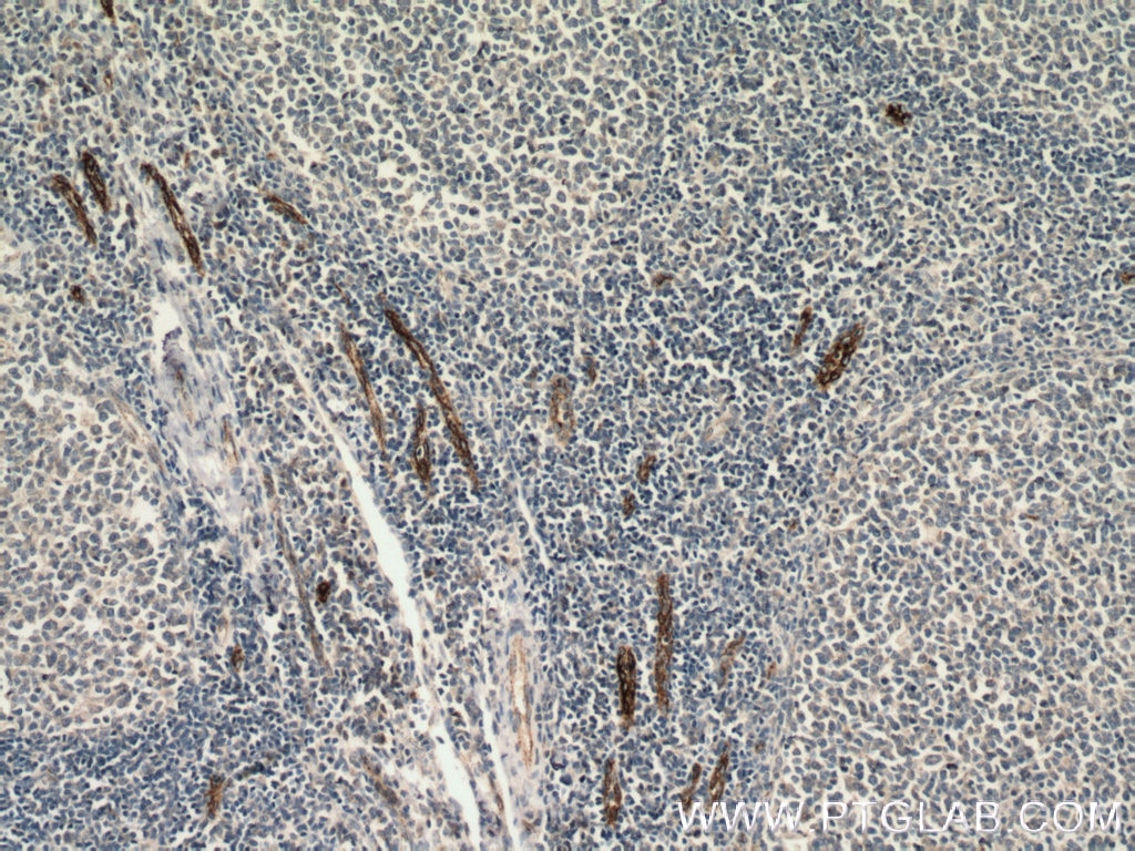 Immunohistochemistry (IHC) staining of human tonsillitis tissue using VWF Monoclonal antibody (66682-1-Ig)