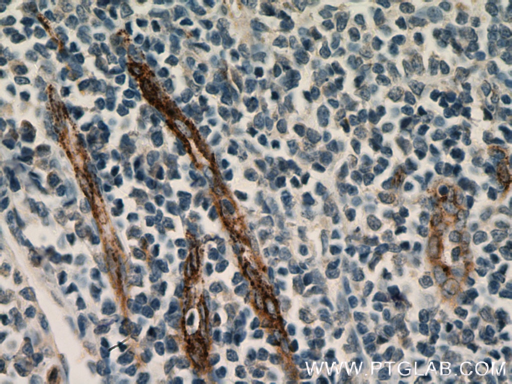 Immunohistochemistry (IHC) staining of human tonsillitis tissue using VWF Monoclonal antibody (66682-1-Ig)