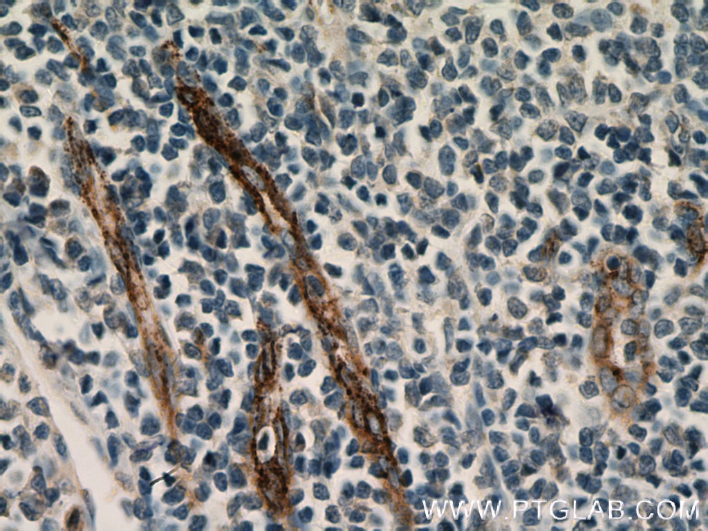 IHC staining of human tonsillitis using 66682-1-Ig