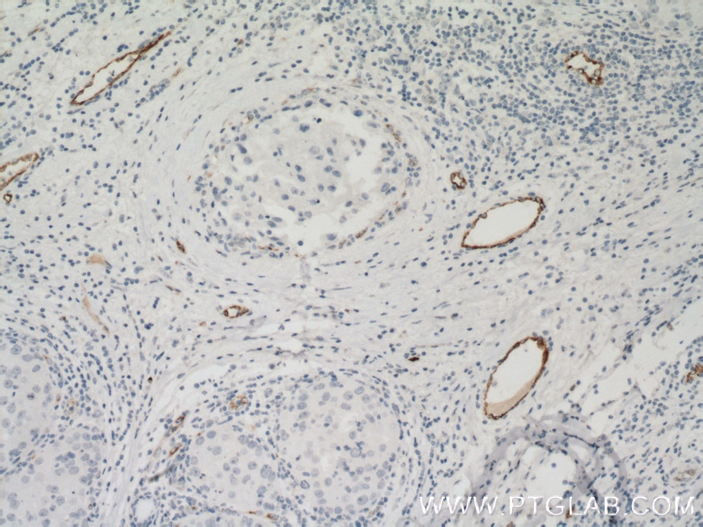 Immunohistochemistry (IHC) staining of human breast cancer tissue using VWF Monoclonal antibody (66682-1-Ig)