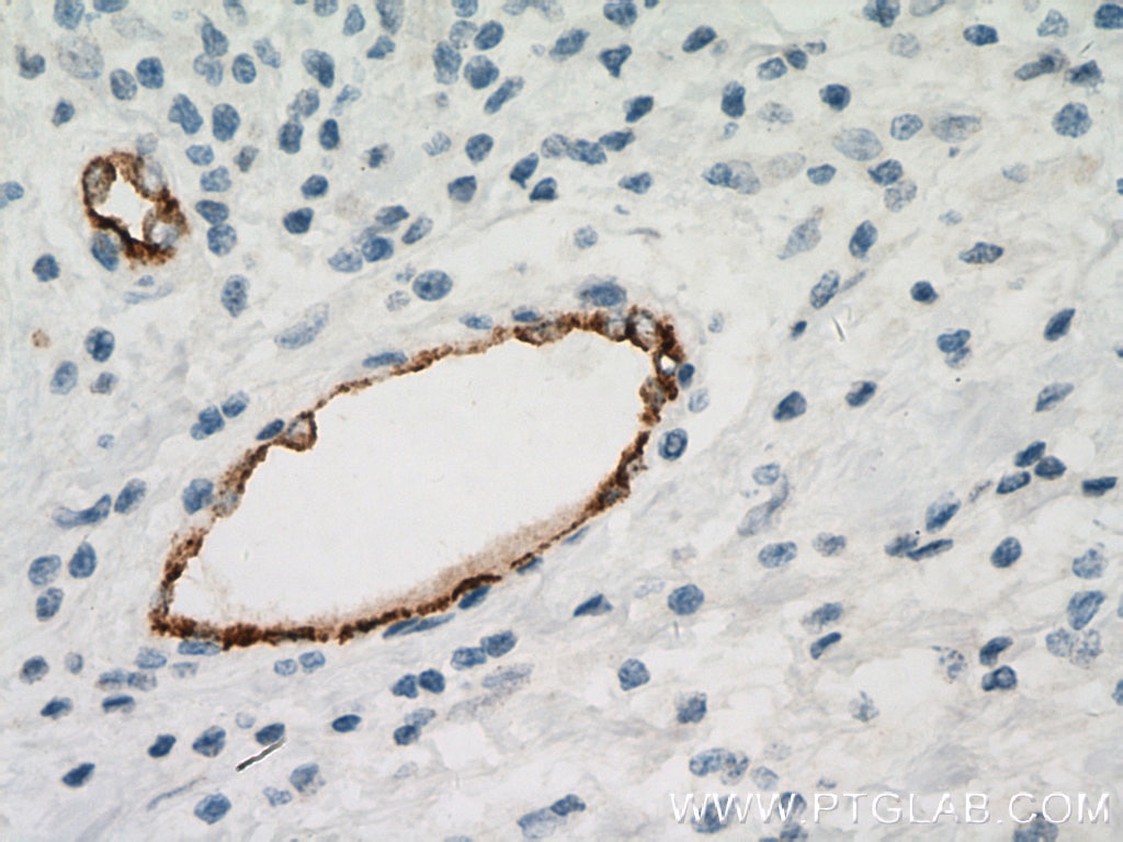 IHC staining of human breast cancer using 66682-1-Ig