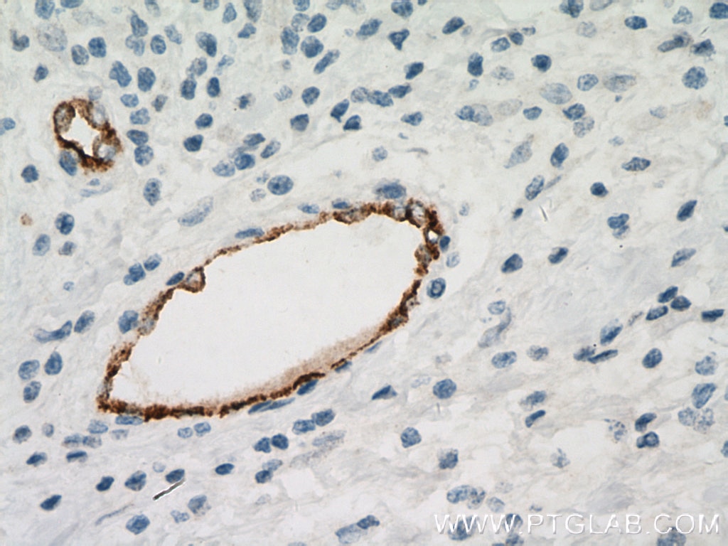 Immunohistochemistry (IHC) staining of human breast cancer tissue using VWF Monoclonal antibody (66682-1-Ig)