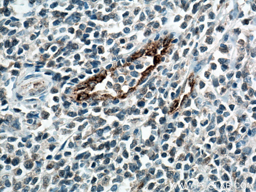 Immunohistochemistry (IHC) staining of human tonsillitis tissue using VWF Monoclonal antibody (66682-1-Ig)