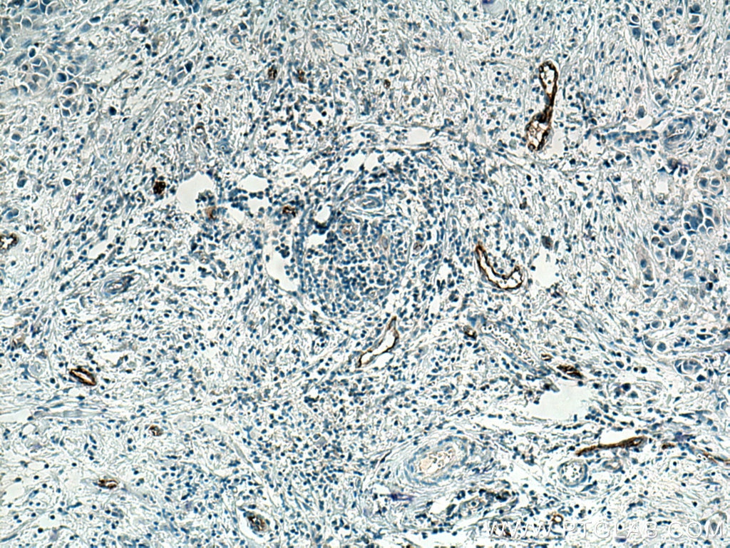 IHC staining of human breast cancer using 66682-1-Ig