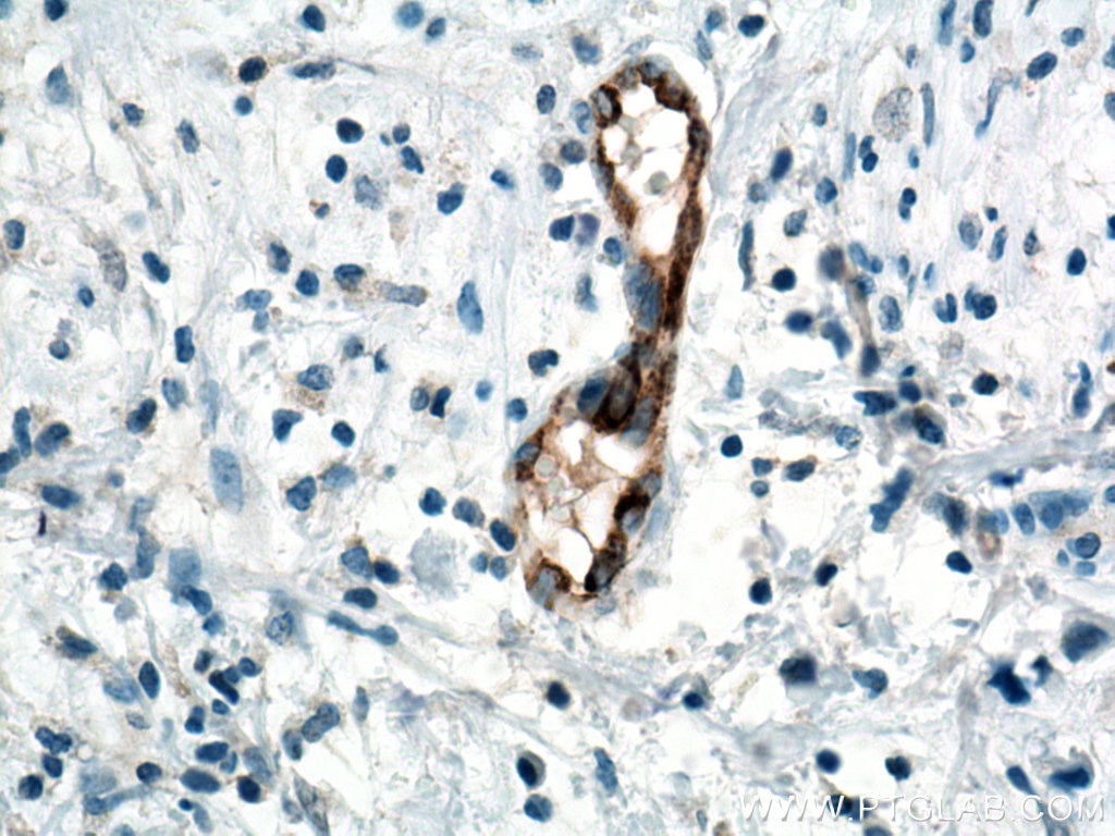 Immunohistochemistry (IHC) staining of human breast cancer tissue using VWF Monoclonal antibody (66682-1-Ig)