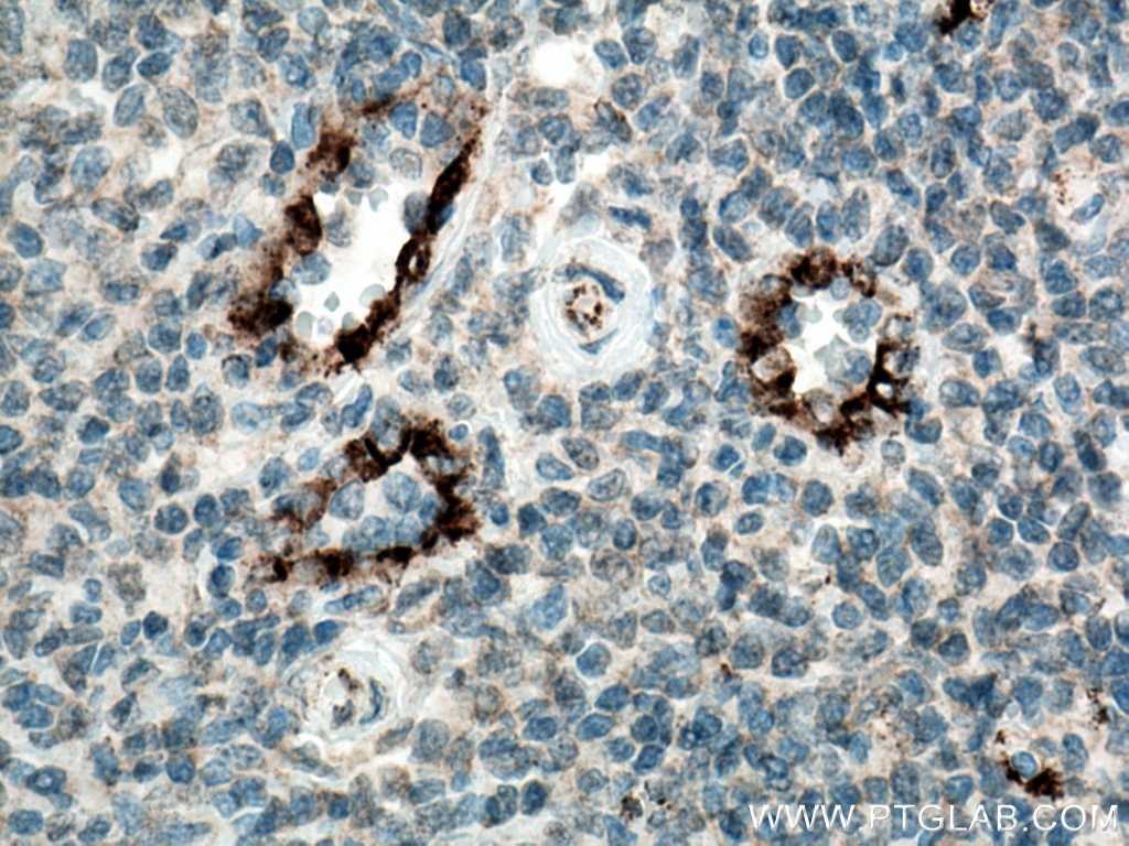 IHC staining of human tonsillitis using 66682-1-Ig