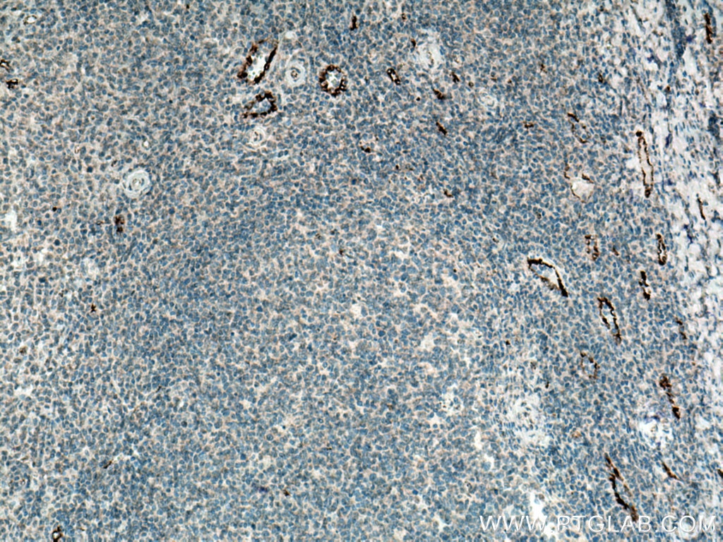 IHC staining of human tonsillitis using 66682-1-Ig