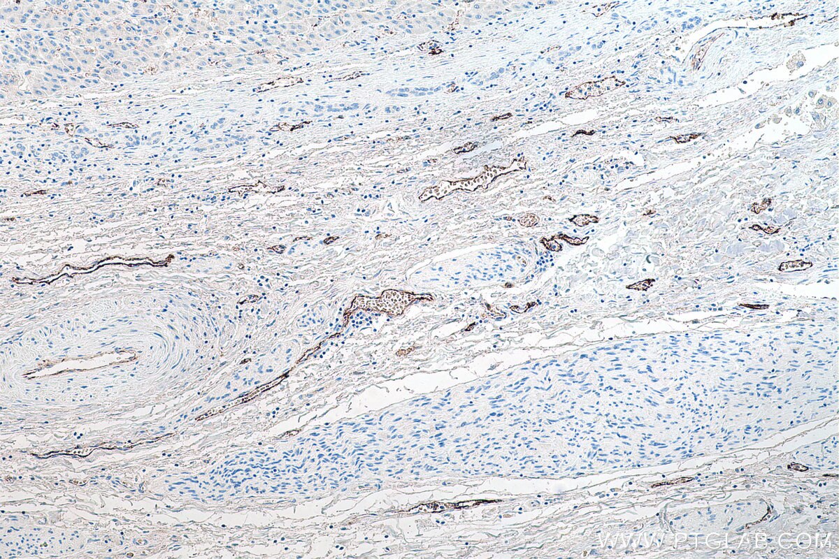 Immunohistochemistry (IHC) staining of human liver cancer tissue using VWF Monoclonal antibody (66682-1-Ig)