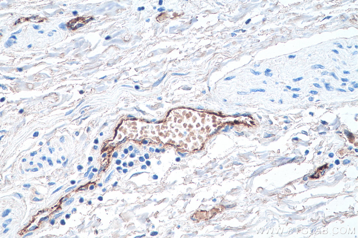 Immunohistochemistry (IHC) staining of human liver cancer tissue using VWF Monoclonal antibody (66682-1-Ig)