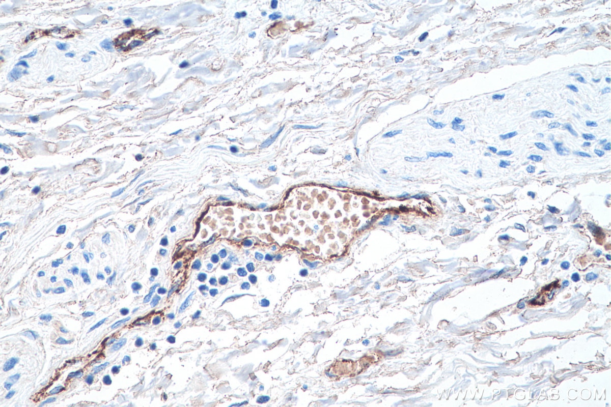 IHC staining of human liver cancer using 66682-1-Ig