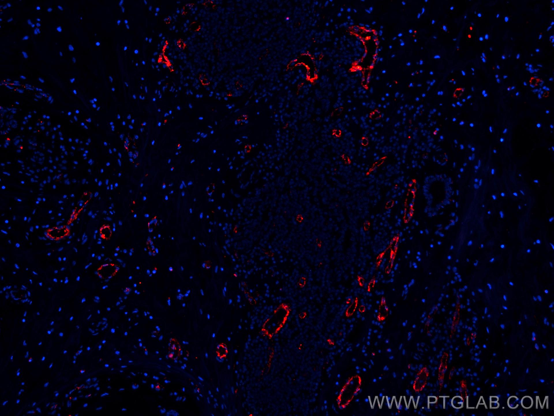 Immunofluorescence (IF) / fluorescent staining of human breast cancer tissue using CoraLite®594-conjugated vwf Monoclonal antibody (CL594-66682)