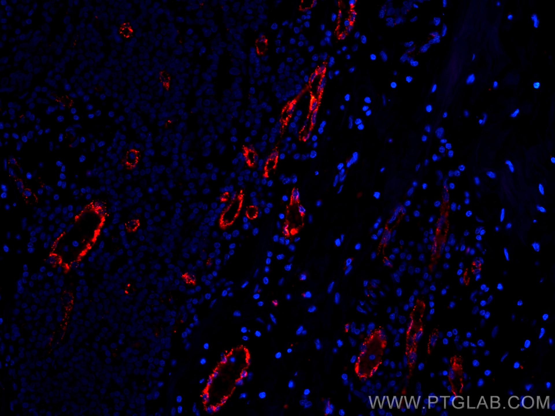 Immunofluorescence (IF) / fluorescent staining of human breast cancer tissue using CoraLite®594-conjugated vwf Monoclonal antibody (CL594-66682)