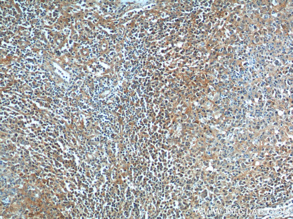 Immunohistochemical (IHC) analysis of paraffin-embedded human lymphoma tissue slide using 10435-1-AP (BAD Antibody) at dilution of 1:200 (under 10x lens).