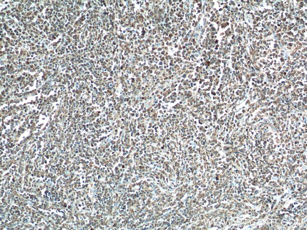 
Immunohistochemistry (IHC) staining of human lymphoma using BCL2 antibody