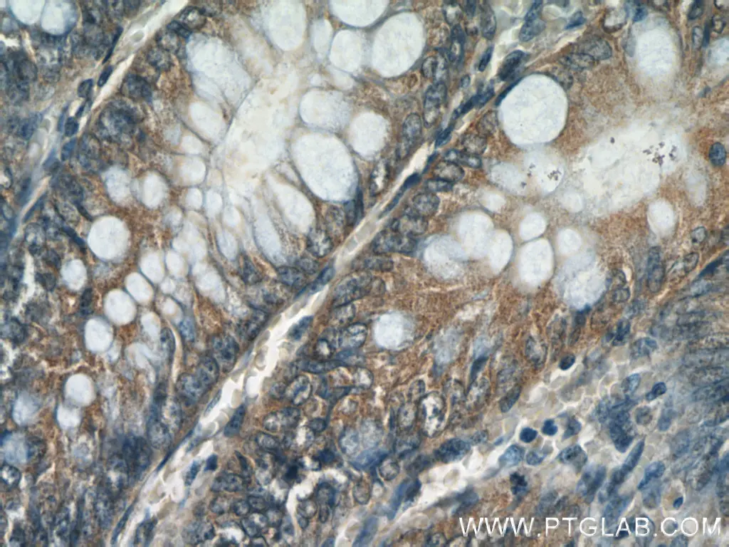 IHC of paraffin-embedded human colon tissue using Caspase 8 antibody (13423-1-AP) at a dilution of 1:50 (40x objective).