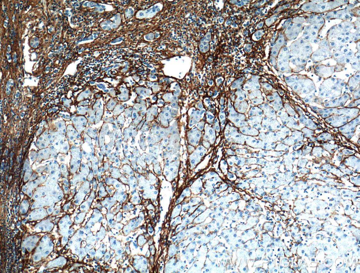 Collagen III抗体を用いたパラフィン包埋ヒト肝硬変組織の免疫組織化学染色