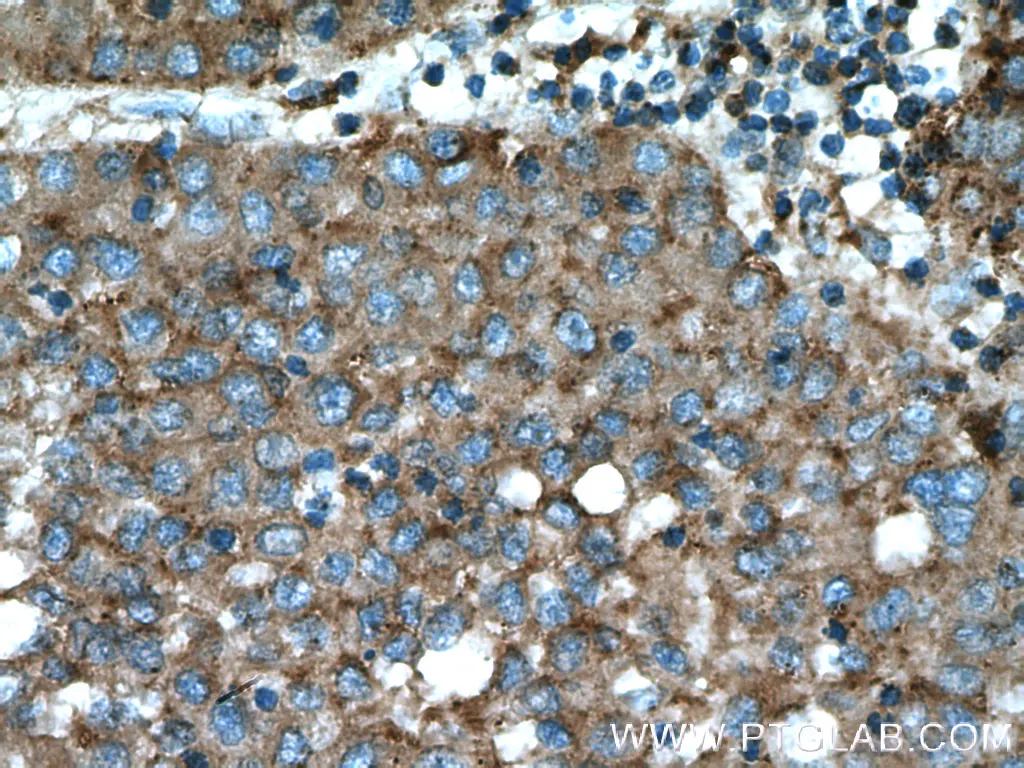 Beta galactosidase抗体を用いたパラフィン包埋ヒト肝臓がん組織の免疫組織化学染色