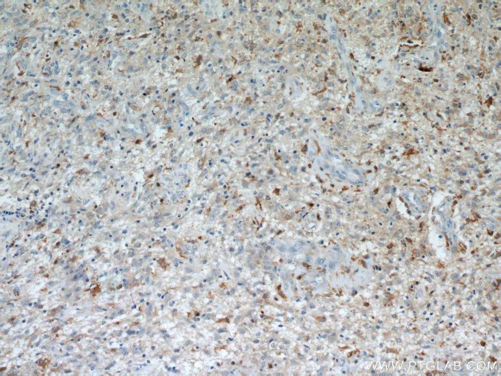 Immunohistochemical analysis of paraffin-embedded human gliomas using Proteintech's IL13RA2 antibody (11059-1-AP) at dilution of 1:50.