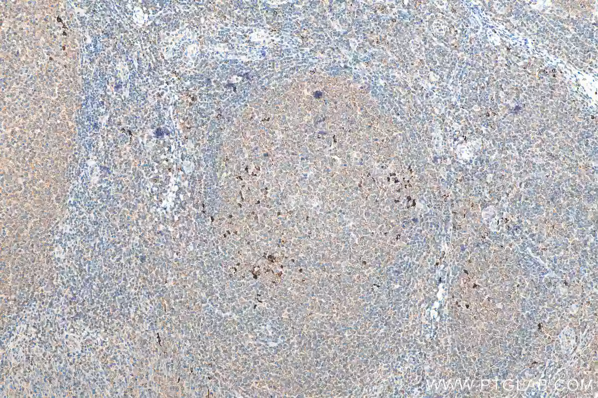 Immunohistochemical (IHC) analysis of paraffin-embedded human tonsillitis tissue slide using 16806-1-AP (IL-1 Beta antibody) at dilution of 1:200 (under 10x lens).
