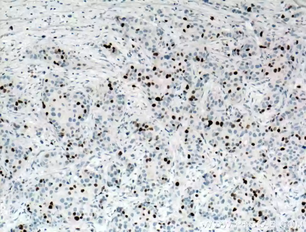 IHC staining of human breast cancer using Ki67 polyclonal antibody