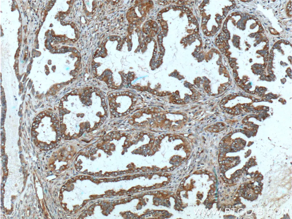 IHC staining of human ovary tumor using MUC16/CA125 polyclonal antibody
