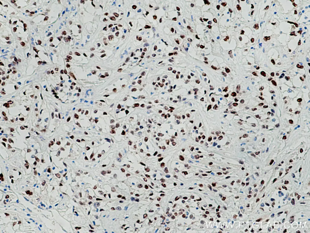 IHC staining of human renal cell carcinoma using PAX8 antibody