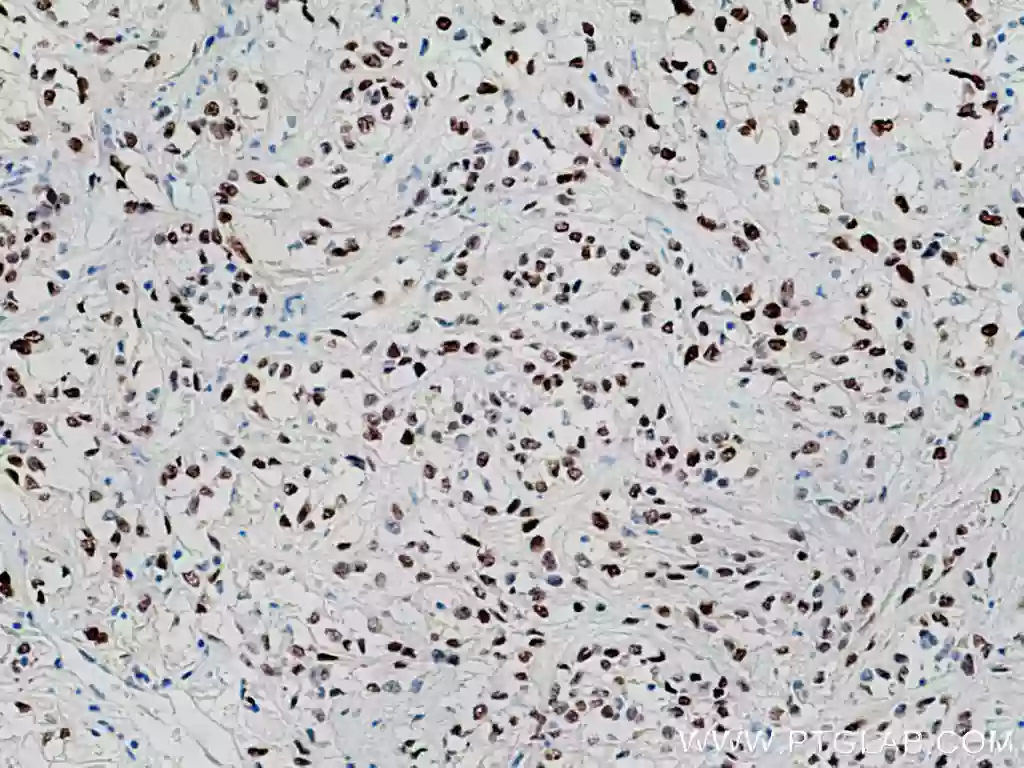 IHC staining of human renal cell carcinoma using PAX8 antibody