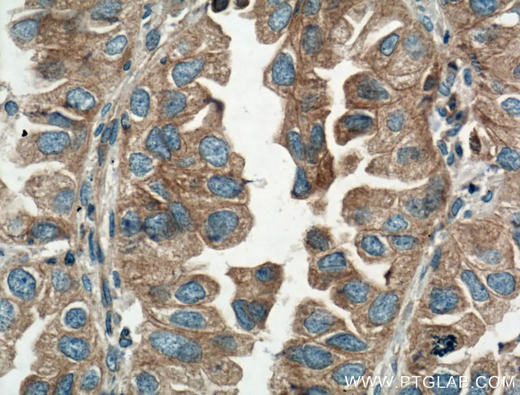 AMPK beta 1抗体を使用した、パラフィン包埋ヒト肺がん組織スライドの免疫組織化学染色
